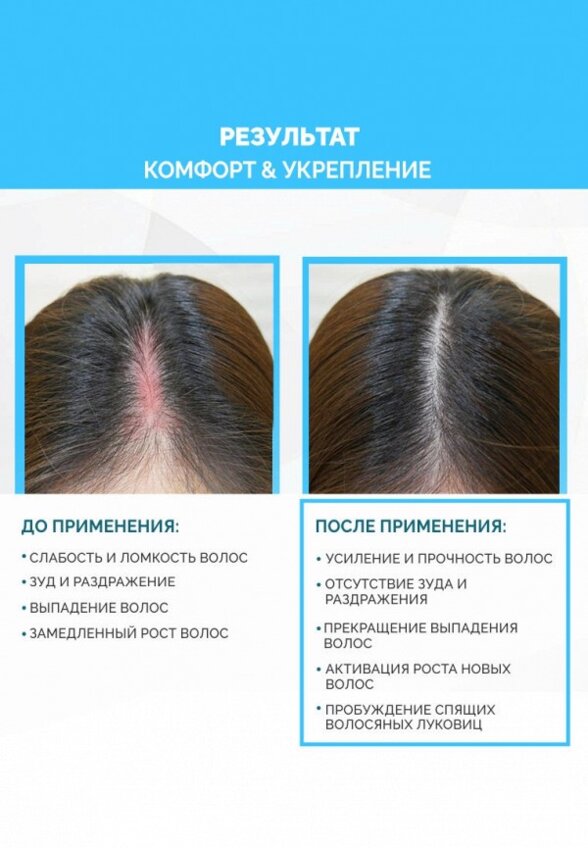 Лосьон для волос Ринфолтил